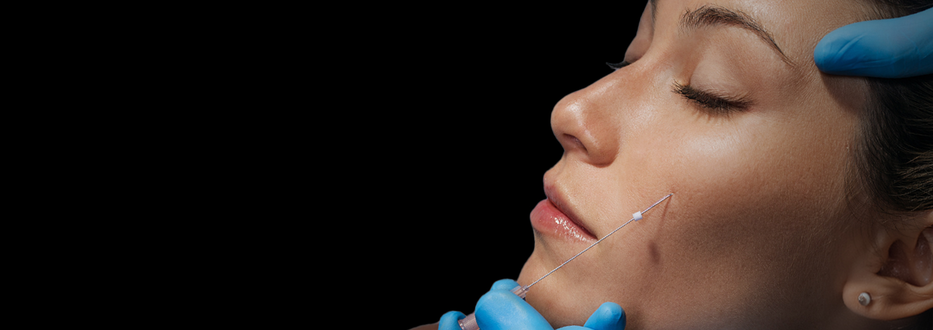 Single Needle Threads: Comprehensive Facial Rejuvenation