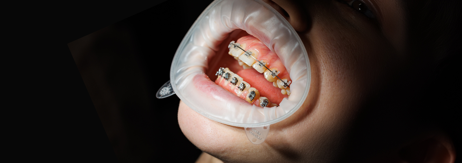 Metal Braces (Traditional Braces)