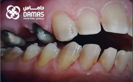 testimoial-Implant  & Hollywood smile